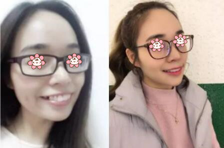 牙齒矯正后悔一輩子真相揭秘，那為什么有人30歲還矯正牙齒