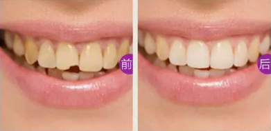 門(mén)牙缺損怎么辦？看湛江珠江口腔做嵌體修復(fù)后真假牙難辨