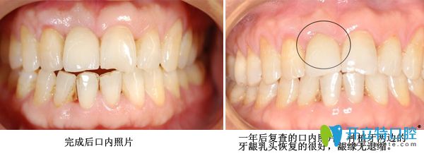 種植牙修復(fù)術(shù)后案例 種植牙修復(fù)術(shù)后案例