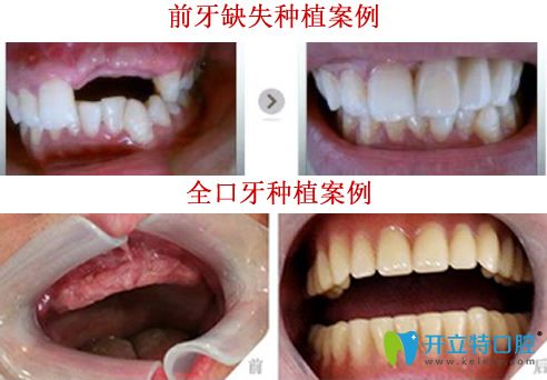 晉中潤(rùn)芽口腔<!--<i data=20240703-sp></i>-->種植牙好嗎？看<!--<i data=20240703-sp></i>-->種植牙案例對(duì)比圖