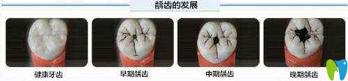 兒童牙齒齲發(fā)展階段