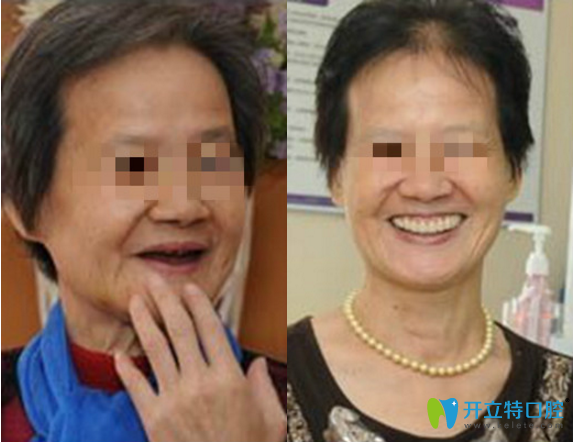 邵陽(yáng)雅貝康口腔牙種植與牙美容修復(fù)真人案例