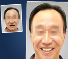 真人案例：廈門宏沅膛口腔60歲老人種植牙術前術后效果對比