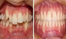 隱形矯正有用嗎？看自貢新橋口腔3D數(shù)碼隱形矯正案例效果