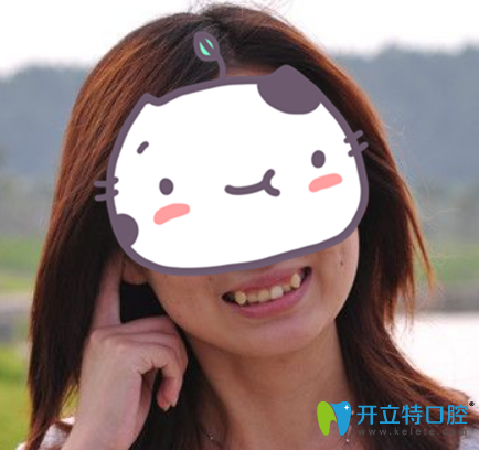 沒有武漢愛齒爾口腔正畸前樣子