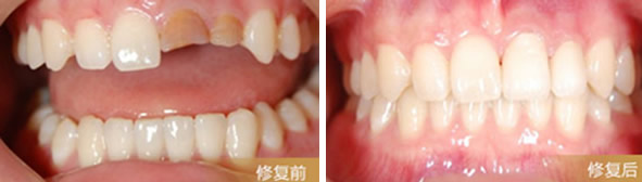 朋友問天津陽光樹口腔是公立還是私立？烤瓷牙做的怎么樣