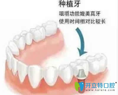 新疆凱樂口腔解惑 為什么單顆種植牙價(jià)格趕上奢侈品LV價(jià)格