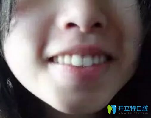 骨性齙牙帶牙套有用嗎?分享我去賽德陽(yáng)光做矯正2年后的變化