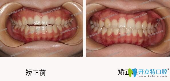 成都口腔哪里正畸好？圣貝口腔牙齒矯正效果來(lái)揭曉
