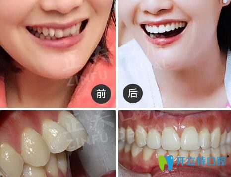 深圳正夫口腔正畸怎么樣？看多組正夫口腔牙齒矯正評(píng)價(jià)