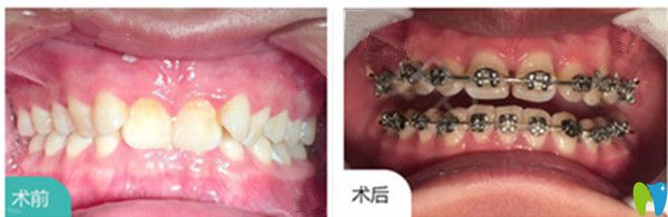 吉林愛(ài)齒口腔耿悅牙齒矯正對(duì)比圖