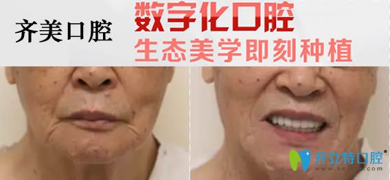 重慶齊美口腔60歲老人全口種植牙對比效果