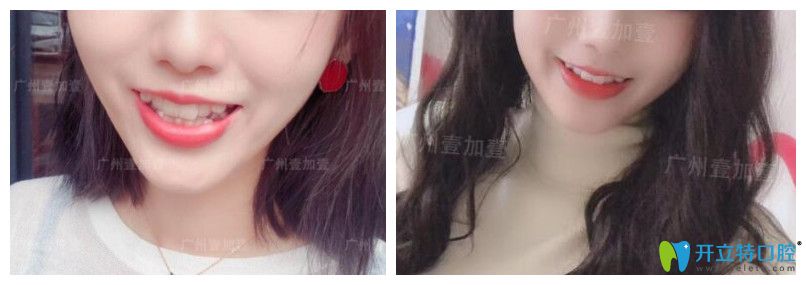 正畸和瓷貼面修復(fù)顧客用案例驗證廣州壹加壹口腔怎么樣