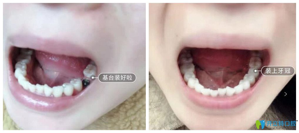 廣州圣貝口腔單顆種植牙案例