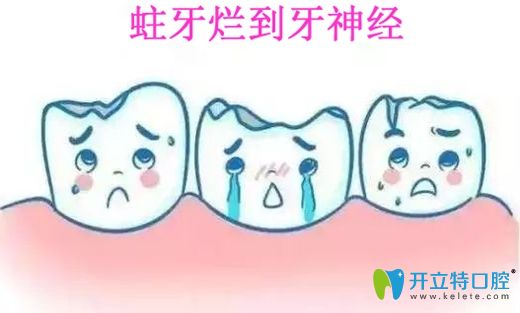 蛀牙怎么確定爛到神經(jīng)簡(jiǎn)單,重點(diǎn)是牙齒爛神經(jīng)該怎么辦