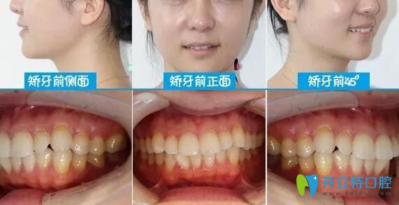 顏值逆襲!從深圳下沙韋博口腔戴隱適美牙套矯正齙牙開(kāi)始