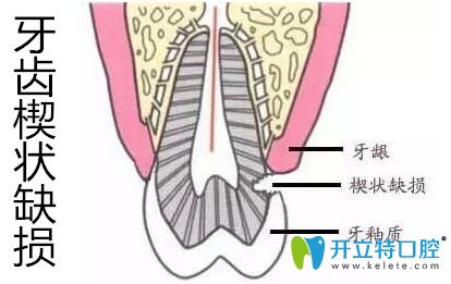 牙齒楔狀缺損千萬(wàn)不要盲目補(bǔ)牙,先弄清楔狀缺損的修復(fù)方法