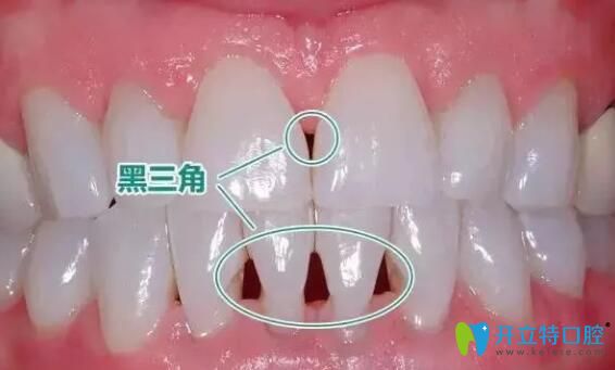 牙周炎導(dǎo)致的黑三角怎么辦？可以做貼面改善嗎