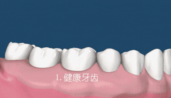 牙黃有牙結(jié)石,曬在東營(yíng)鉑爾口腔做冷光美白牙齒兩年后照片