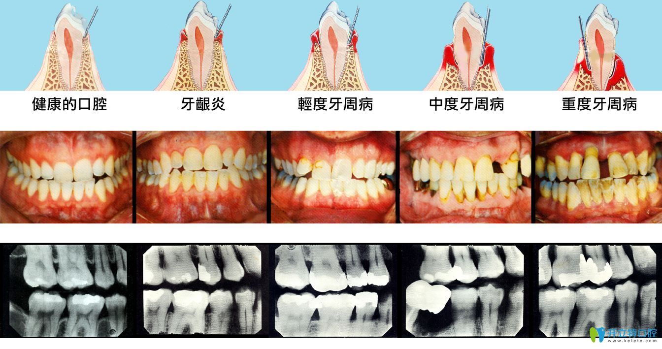 牙周炎牙齒松動怎么辦,需不需要拔牙要看能否固定恢復