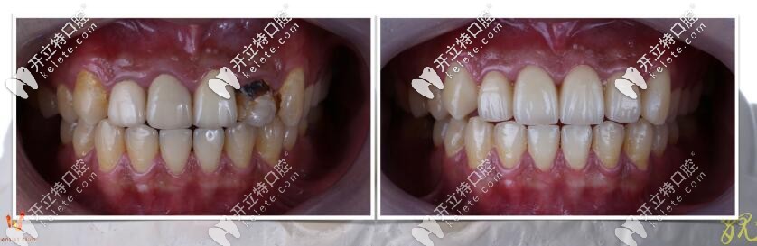 ?？谖⑿谇豢敬裳罁Q全瓷牙真人案例
