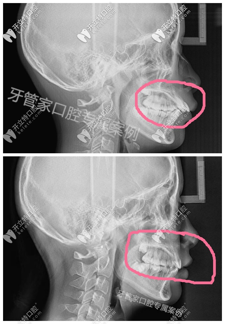 骨性齙牙帶牙套有效果，下牙套后我的骨性牙齒內(nèi)收了6毫米