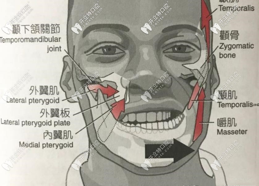 什么是穿顴穿翼種植牙技術?穿顴穿翼種植牙示意圖讓你秒懂