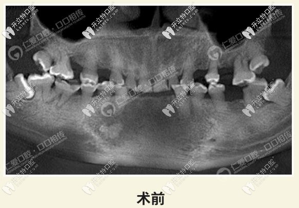 <!--<i data=20240703-sp></i>-->口腔牙齒磨耗治療<span style=