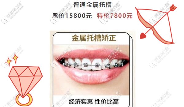 廣州圣貝傳統(tǒng)金屬托槽矯正才7800元啦,暑假正畸不造起來嗎？