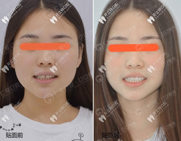 牙齒不齊武漢美加超薄瓷貼面修復(fù)體驗(yàn),超nice牙貼面醫(yī)生推薦