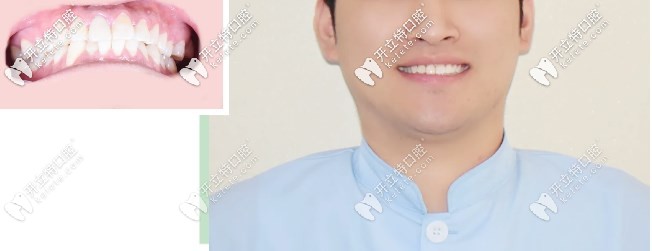 正畸醫(yī)生牙齒前凸戴隱適美隱形矯正，告訴你你不知道的事