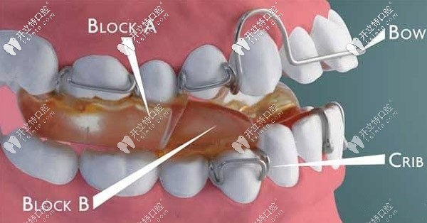 twinblock雙頜墊矯治器,對兒童下頜后縮有較大的改善