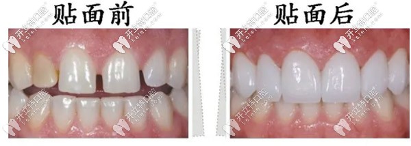 全瓷牙貼面用于前牙美學(xué)修復(fù)的主要優(yōu)勢體現(xiàn)在哪里？