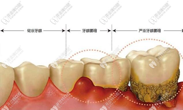 牙齦萎縮后牙根還能補(bǔ)嗎?牙根總是敏感怎么辦？