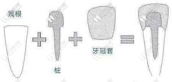打樁補(bǔ)牙和鑲牙哪種效果好,大概能用多少年？
