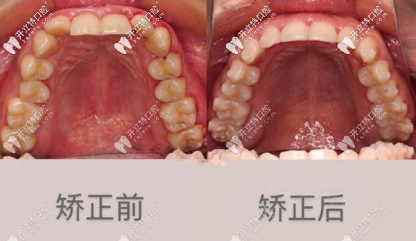 牙齒內(nèi)傾 