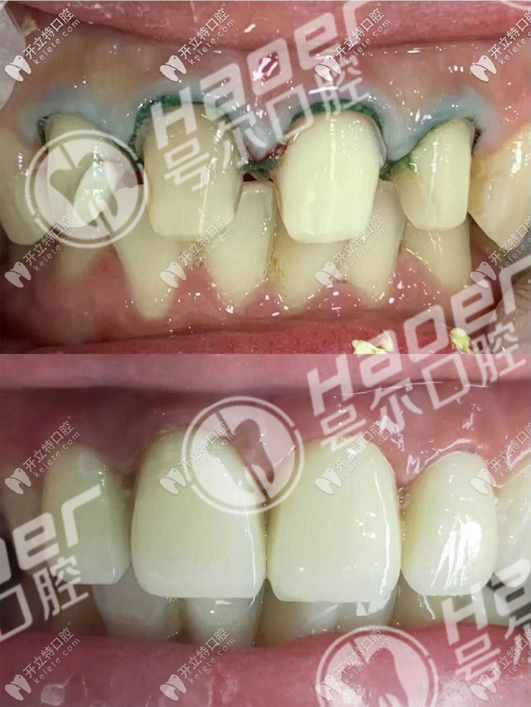 說不痛苦是假的,談?wù)勎铱敬裳烙?年后拆了換全瓷牙過程！