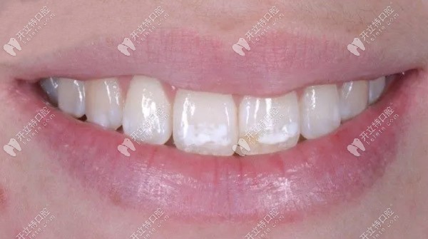 滲透樹(shù)脂治療氟斑牙的效果怎么樣，請(qǐng)看案例