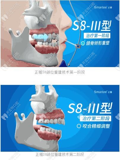 正雅S8、S9、S10頜位重建術(shù)